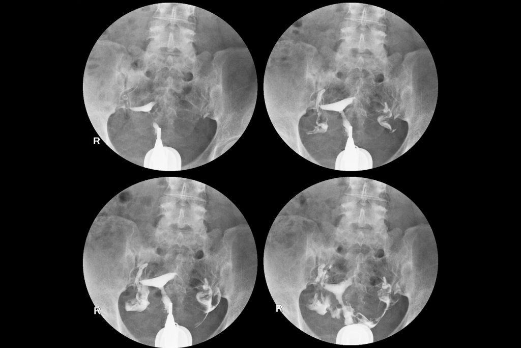 histerosalpingografia